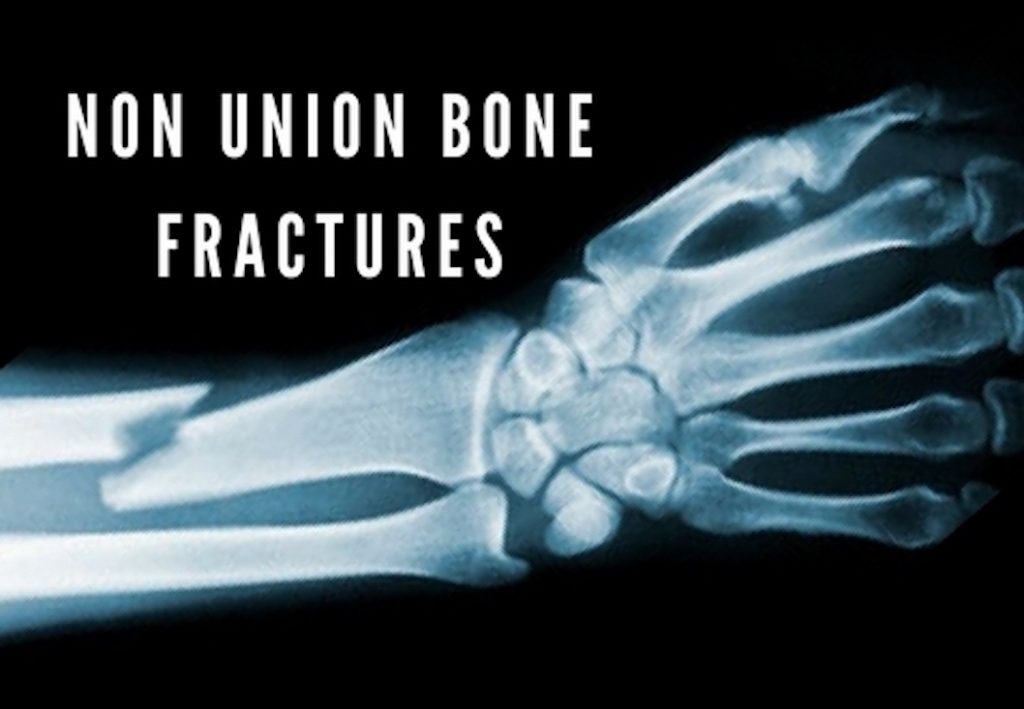 Non Union Bone Fractures – Bone Health Initiative